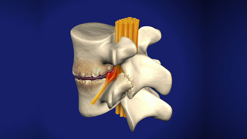 dureri severe de spate în regiunea lombară dureri pungioase la nivelul coloanei vertebrale